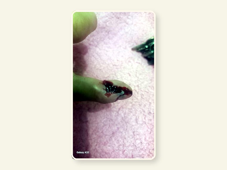 Weeper Finger Byte — shown as an educational reminder of the risks, injuries and behavioural realities involved in exotic animal ownership.
